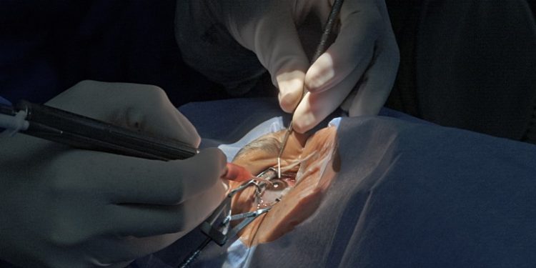 Jaru: Atendimentos do mutirão de catarata começam nesta terça-feira, 06; agendamentos podem ser realizados em todas as unidades de saúde