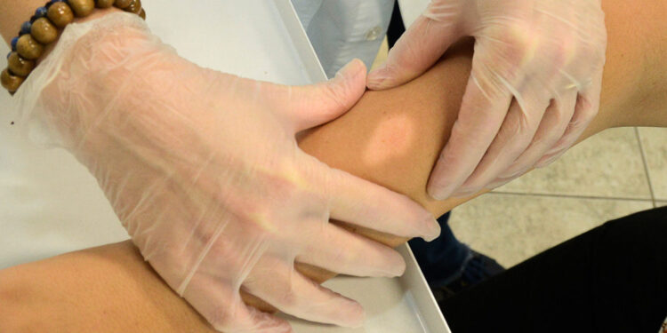 Janeiro Roxo: Prefeitura de Jaru realizará ação para o diagnóstico precoce da Hanseníase; atendimentos serão nos dias 26 e 31 de janeiro