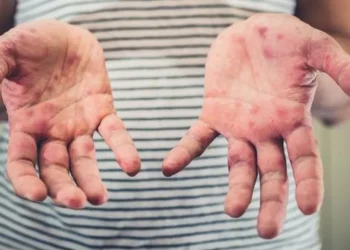 Após surto de Sarampo na Bolívia, Secretaria de Saúde de Jaru intensifica ações de prevenção e reforça importância da vacina contra a doença