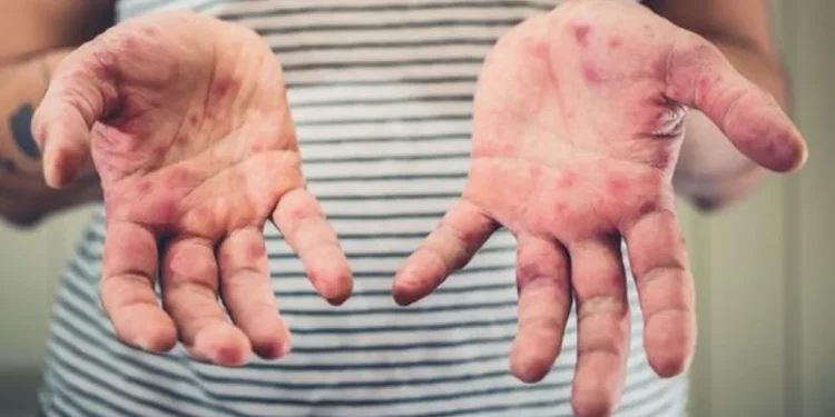 Após surto de Sarampo na Bolívia, Secretaria de Saúde de Jaru intensifica ações de prevenção e reforça importância da vacina contra a doença